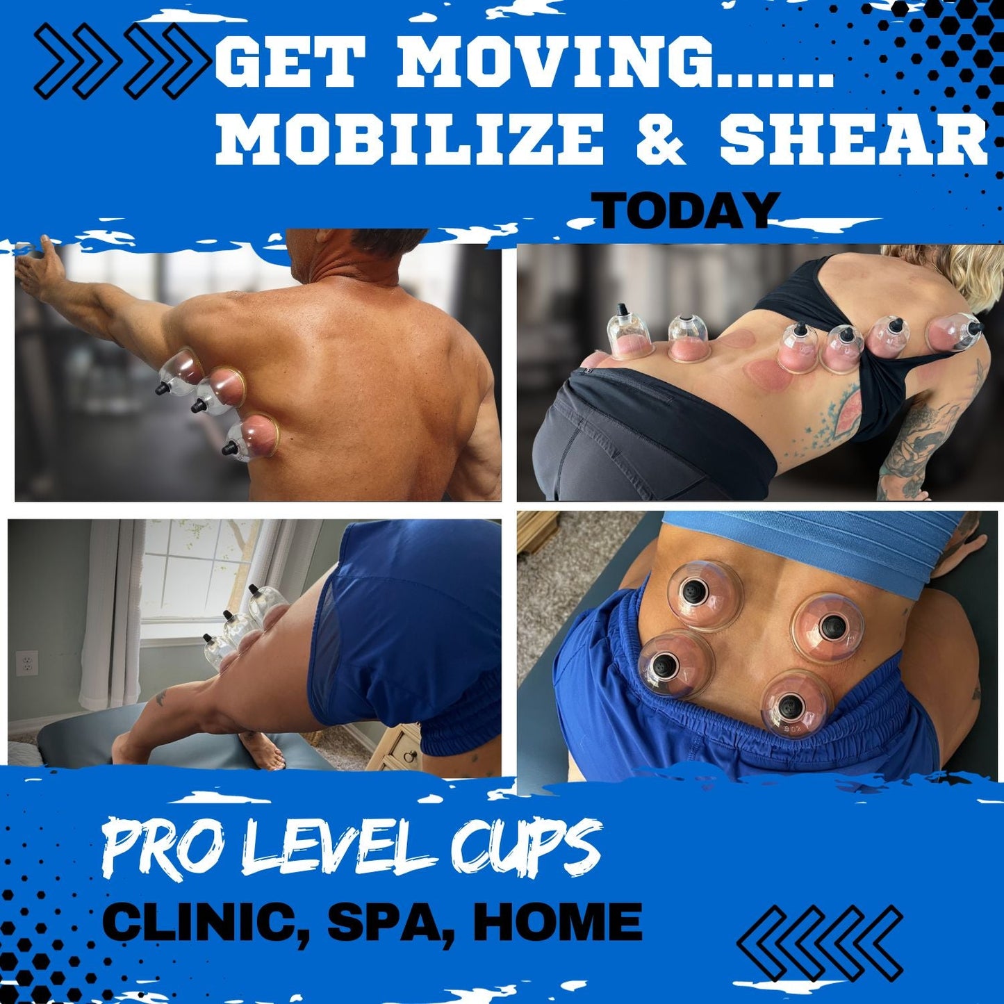 MMT POLY CUPS™ Pump Gun Cupping Set